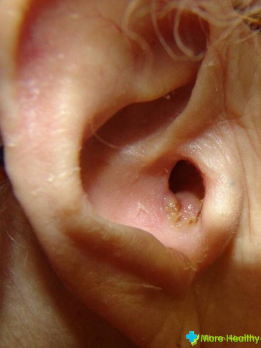 Механическая травма уха фото