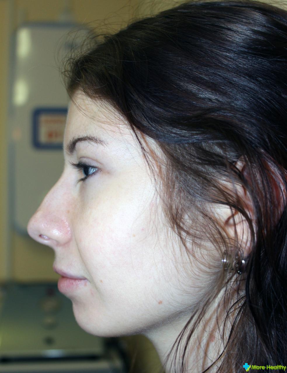 Что делать и как лечить ушиб носа