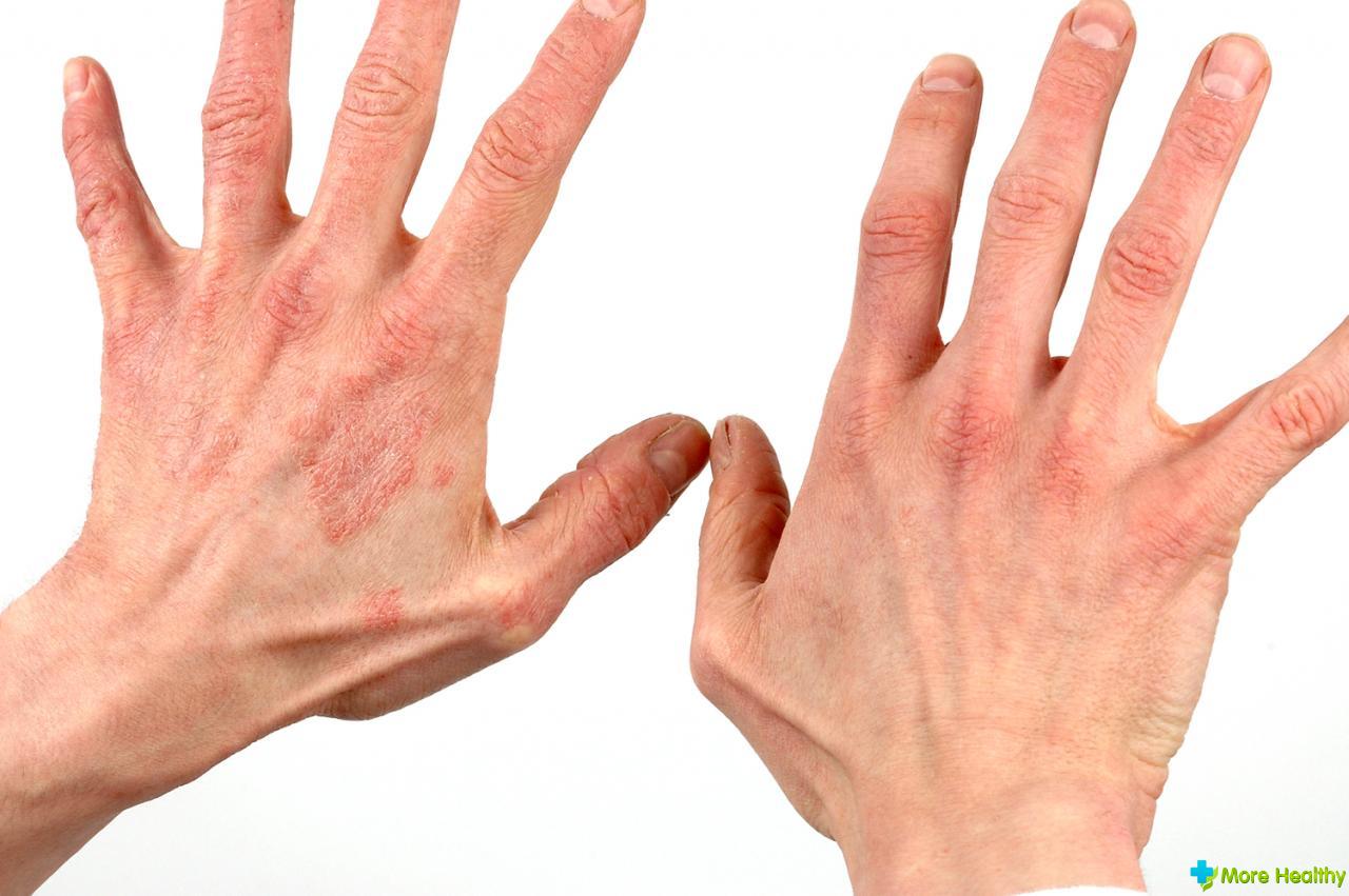 Мази от дерматита на руках: самые доступные и эффективные