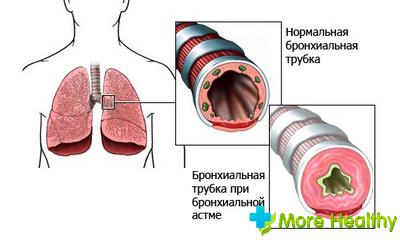 приступ бронхиальной астмы