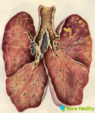 Инкубационный период туберкулеза