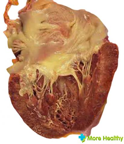 миокардический кардиосклероз