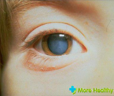 катаракта причины симптомы