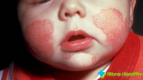 эксфолиативный дерматит новорожденных риттера