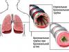 приступ бронхиальной астмы